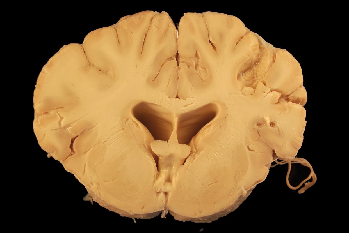 Sustancia blanca del cerebro: definición, estructura, funciones y lesiones