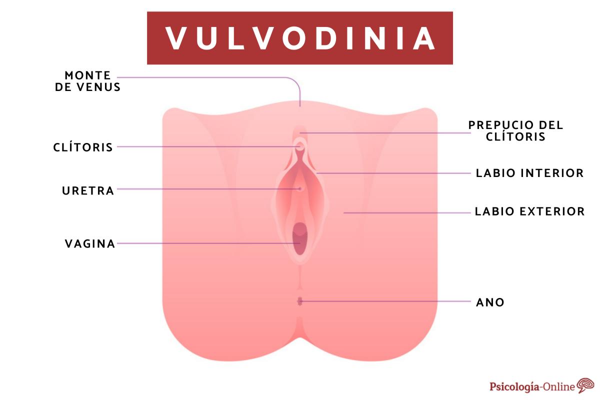Vulvodinia: qué es, síntomas, causas y tratamiento