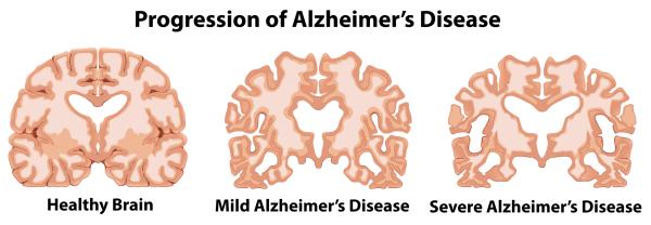 Demencia: qué es, tipos, síntomas y causas - Enfermedad de Alzheimer