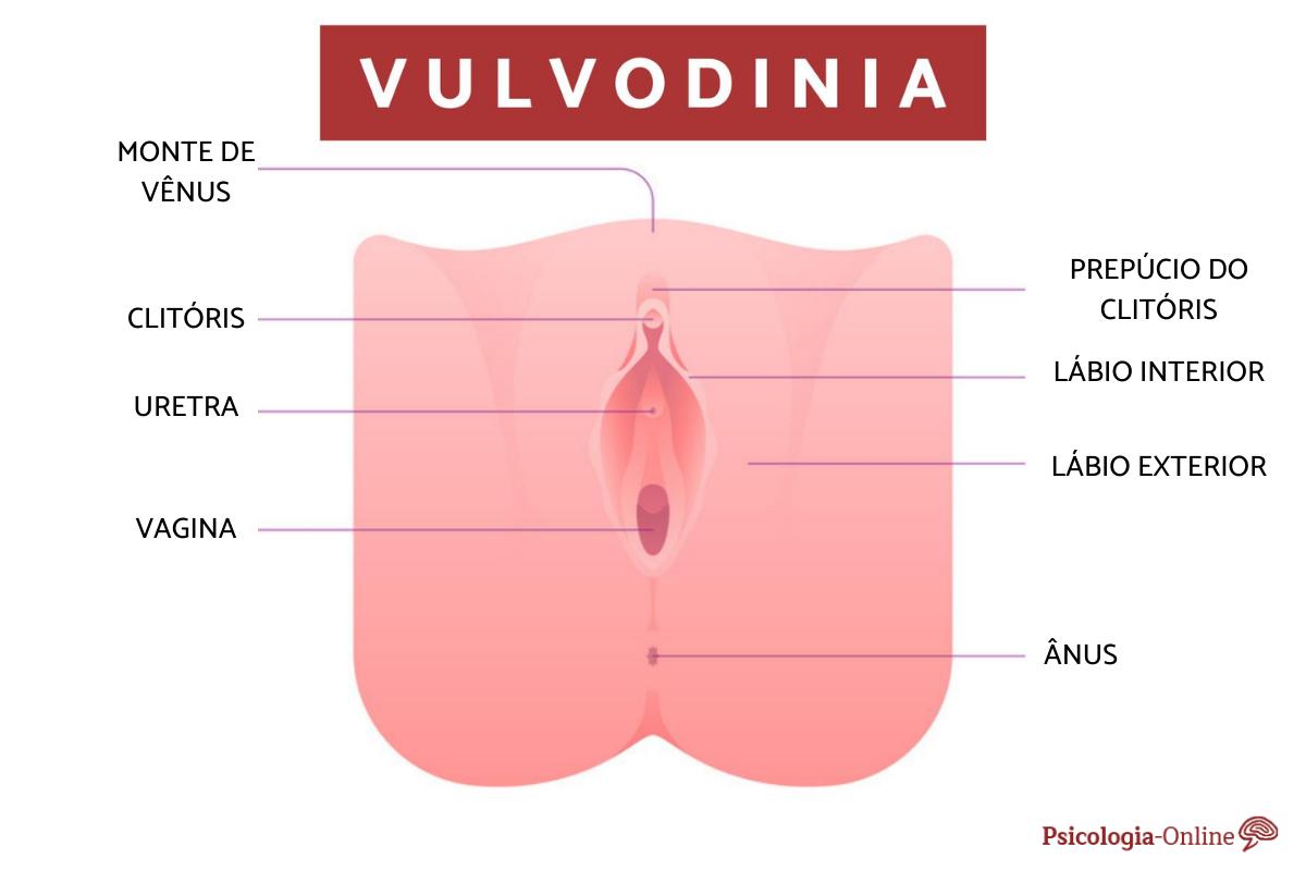 O que é vulvodinia, sintomas, causas e tratamento